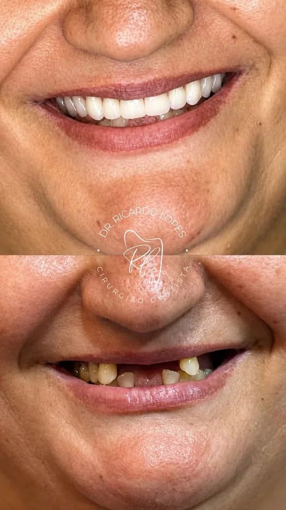 Antes e depois de reabilitação do sorriso realizada pelo Dr. Ricardo Lopes